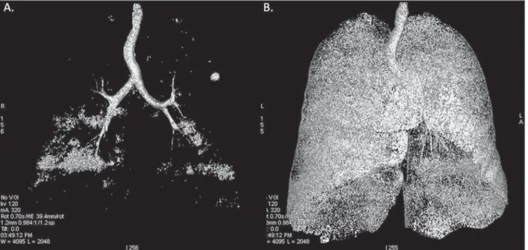Figure 2. A: Three-dimensional representation of pulmonary emphysema index measured with the usual dose and without high-resolution filter