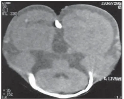 Figure 3. Skull computed tomography performed at the second day of life, confirming both clinical and radiological findings