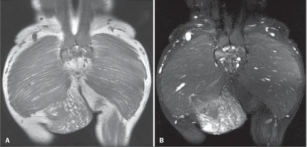 Figura 1. Ressonância magnética, cortes coronais ponderados em T1 sem saturação de gordura (A) e STIR (B).