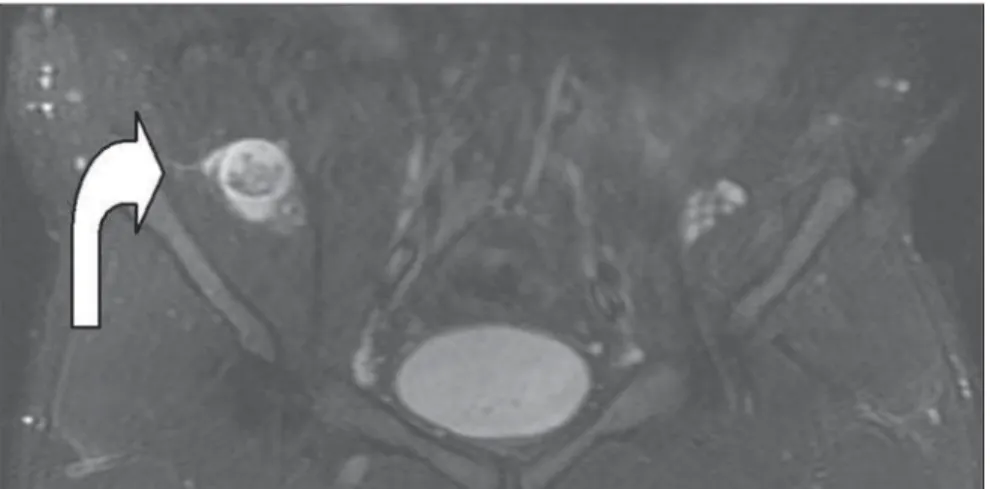 Figure 1. Magnetic resonance imaging, coronal, T1-weighted image without fat saturation (A) and STIR image (B)  demon-strate an expansile heterogeneous,  ill-de-fined mass in contact with the right gluteus maximus and the ischio-rectal fossa,  infil-tratin