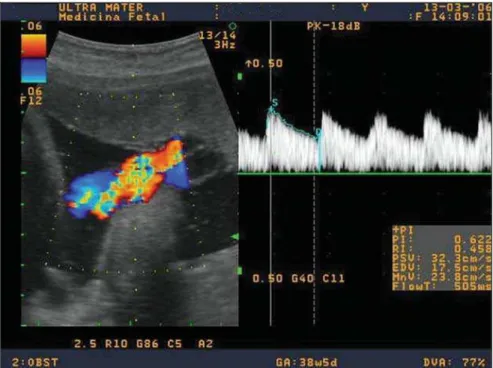 Figure 1. Doppler velocimetry of the umbilical artery close to the placental insertion.