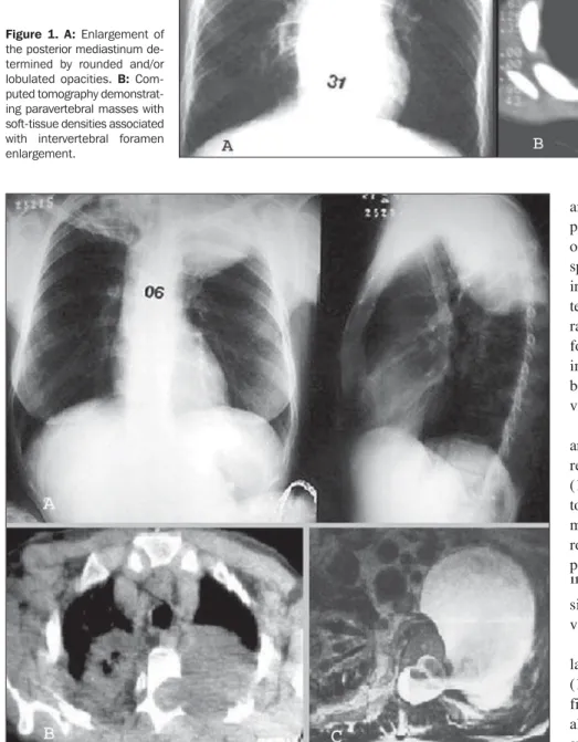 Figure 1.  A: Enlargement of the posterior mediastinum  de-termined by rounded and/or lobulated opacities