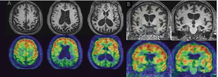 Figure 3. G.M.R., a 62-year-old patient presenting progressive memory loss for one year