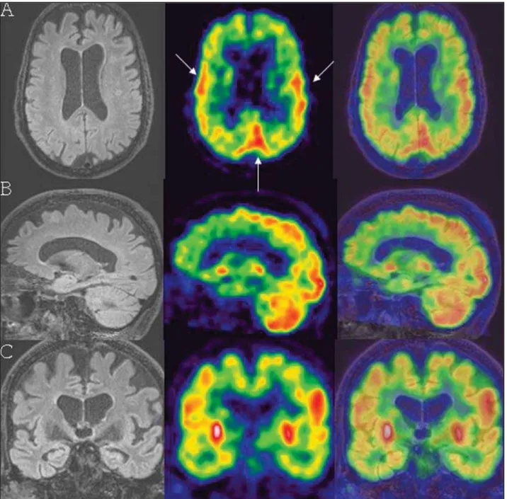 Figure 4. E.J.M., a 68-year-old patient with clinical diagnosis of frontotemporal dementia for four years