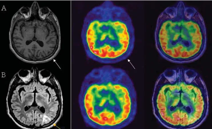 Figure 7. G.M.R., a 30-year-old patient with epilepsy refractory to drug therapy. On line A, a subtle hypo-uptake is observed in the occipito-parietal lobe at left, with no change at MRI T1-weighted sequence (white arrows)