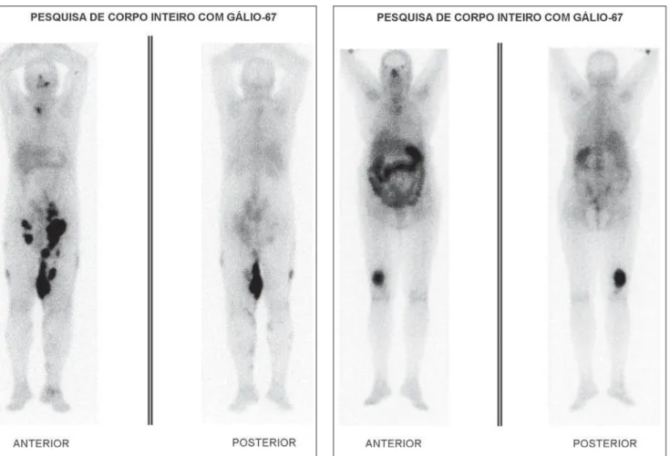 Figure 3. Gallium-67 scintigraphy. Early staging demonstrates gallium up- up-take by lesions on the medial aspect of left thigh, extending from the  in-guinal-pelvic region to the knee.