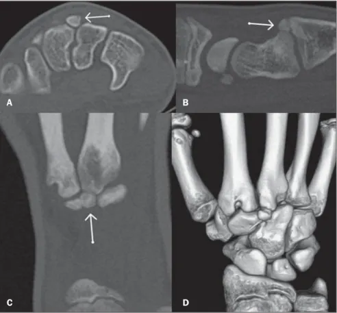 Figure 2. Magnetic resonance imaging demonstrating the accessory ossicle with decreased signal in- in-tensity on axial, fast spin-echo, T1-weighted sequence (A), increased signal inin-tensity on T2-weighted sequence with fat-suppression (B), gadolinium upt