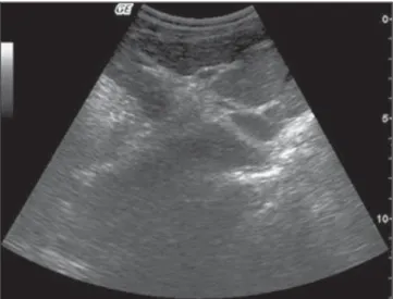 Figure 3. Intense central and peripheral periportal thickening. “Fc” pattern according to the Niamey Working Group, 2000 – WHO classification.