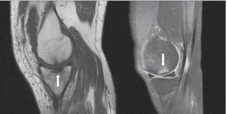 Figure 2. Sagittal (T1-weighted FSE / DP FSE) images showing linear subchondral abnormality (arrows).