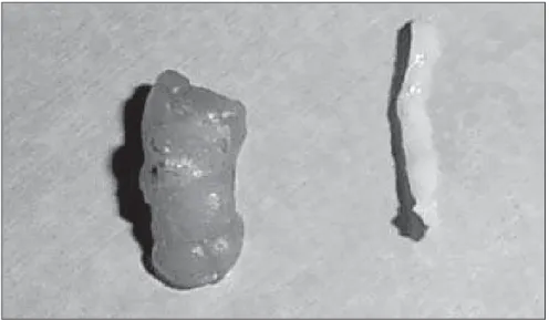 Figure 5. Radiographic image of one fragment retrieved with the device in study containing  repre-sentative calcifications of the lesion.