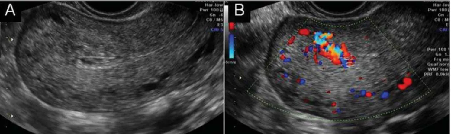 Figure 3. Absence of retained products of conception. A: Endometrial thickness of 5 mm with small intracavitary contents corresponding to coagula