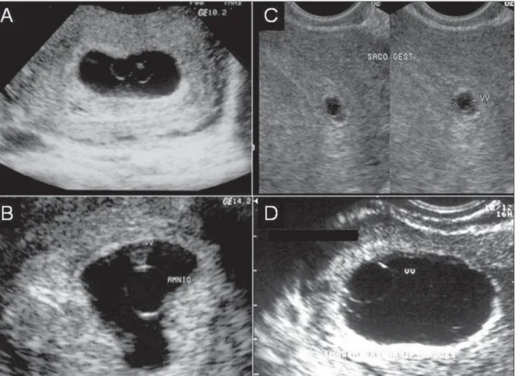 Figure 6. Sonographic signs of early embryo death. A,B: Small amniotic cavity. C: Delayed growth of the gestational sac with disproportionate yolk sac