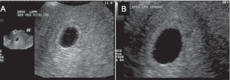 Figure 9. Partial hydatidiform mole. Thick, irregular trophoblast, with sonographic signs suggesting anembryonic gestation