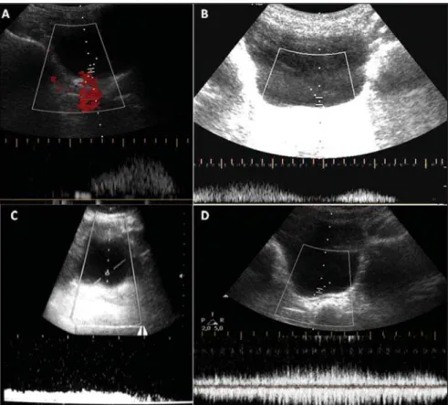 Figure 1. Common patterns in the study. On A, a well defined peak is noticed, characterizing a monophasic ureteric jet