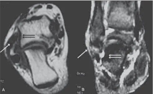 Figure 1. Axial (A,C), and sagittal (B) T1-weighted images of a patient presenting repetition torsion, complaining of pain in the anterolateral region of the ankle, demonstrating poorly individualized anterior talofibular ligament with an small avulsioned 