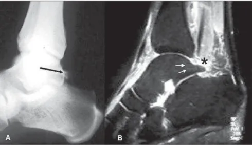 Figure 6. Lateral ankle radiography (A), sagittal STIR MRI sequence (B), and T1-weighted (C) images demonstrating the presence of os trigonum (double arrows) with bone marrow edema