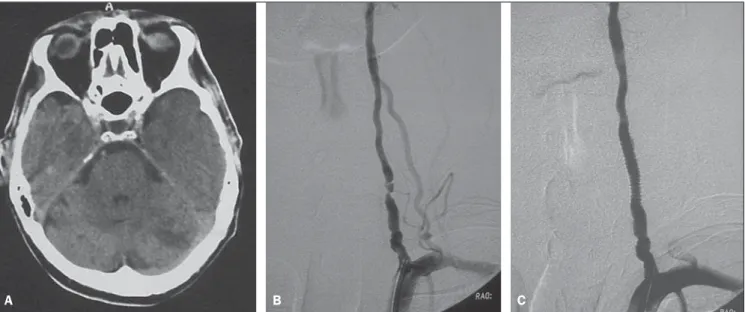 Figure 1. A: Cranial computed tomography demonstrating hypodense lesions in both cerebellar hemispheres, the largest lesion in the left hemisphere