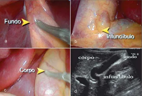 Figure 2. Patient with dyspepsia. Observe the withered gallbladder with thickened wall (arrow) at the first evaluation (a), appearance which is maintained after 12-hour fasting (arrowheads on b)