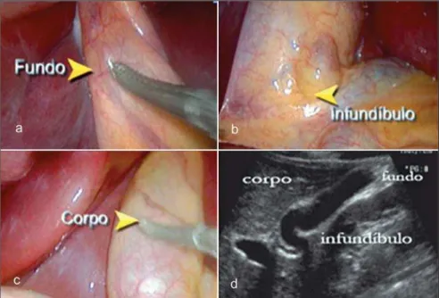 Figure 2. Patient with dyspepsia. Observe the withered gallbladder with thickened wall (arrow) at the first evaluation (a), appearance which is maintained after 12-hour fasting (arrowheads on b)