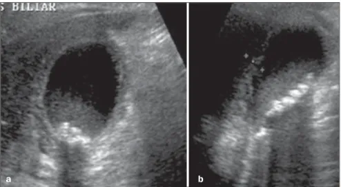 Figure 4. Female, 45-year-old patient with severe abdominal pain in the right hypochondrium, irradiat- irradiat-ing to the scapular region