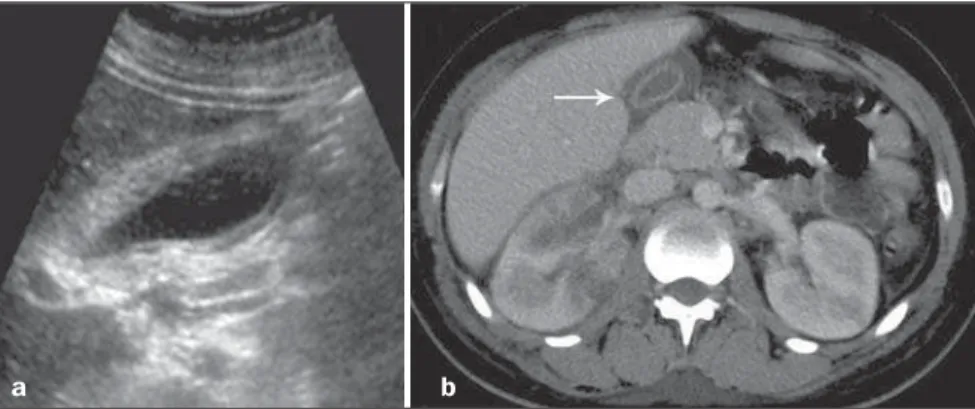 Figure 6. Acalculous cholecystitis. Observe diffuse gallbladder wall thickening, with flow at color  Dop-pler and a minor, adjacent fluid collection