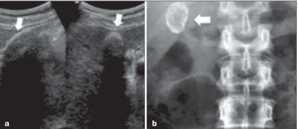 Figure 9. Abdominal US and radiograph of a 50-year-old patient presenting with abdominal discomfort.