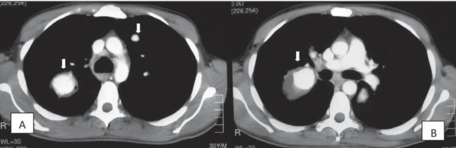Figure 2. Chest computed tomography, lung window, demonstrating aneurysmal dilatations characterized by nodular formations in the upper (arrows on A), middle and lower left lung lobes (arrows on B).