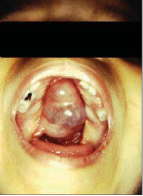 Figure 1. Basal sphenoethmoidal encephalocele.