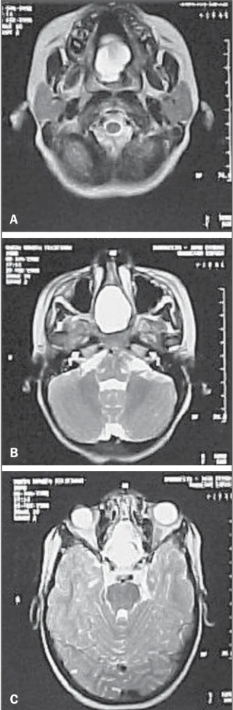 Figure 3. MRI, axial section demonstrating show- show-ing ethmoid and sphenoid defect on the midline with nasal extension, besides a hard palate defect (T2).