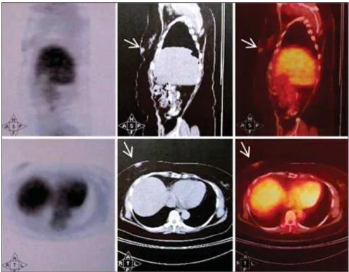 Figure 1. Positron emission tomography/computed tomography (FDG-PET/TC) demonstrating increases FDG uptake in a breast (arrows).