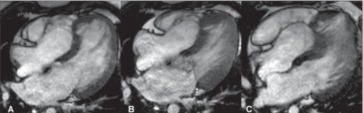 Figure 2. Images acquisition with ECG-gating. Delayed enhancement, long axis four-chambers