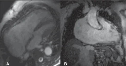 Figure 1. Images acquisition with ECG- ECG-gating, in cine-Fiesta sequence (SSFP), long axis four-chambers