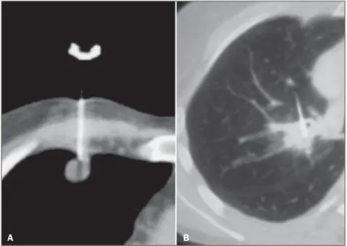 Figure 1. Computed tomography-guided transthoracic needle biopsy of pulmonary nodules