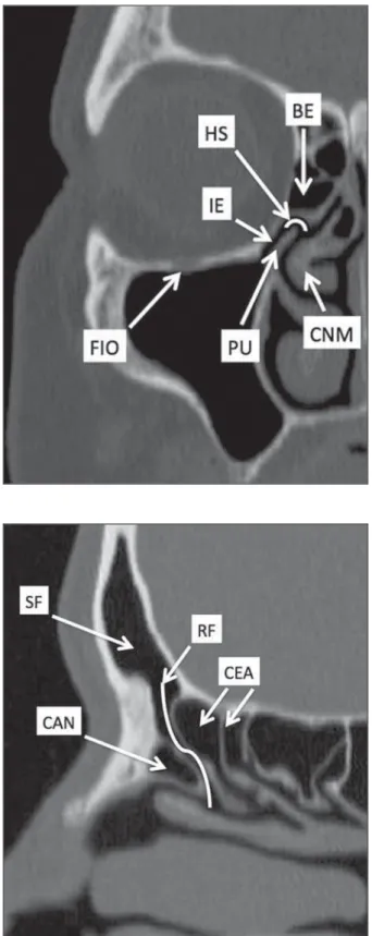 Figure 2. Frontal recess (RF) anatomy in the sagittal plane and its relationship with the anterior ethmoid cells (CEA).