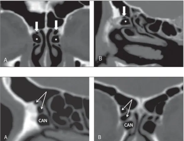 Figure 5. Coronal (A) and sag- sag-ittal (B) images demonstrating type I frontal cells (arrows) and their intimate relationship with agger nasi cells (asterisks)