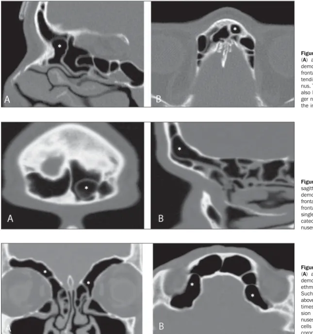 Figure 9. Coronal coronal (A) and axial (B) images demonstrating supraorbital ethmoid cells (asterisks).