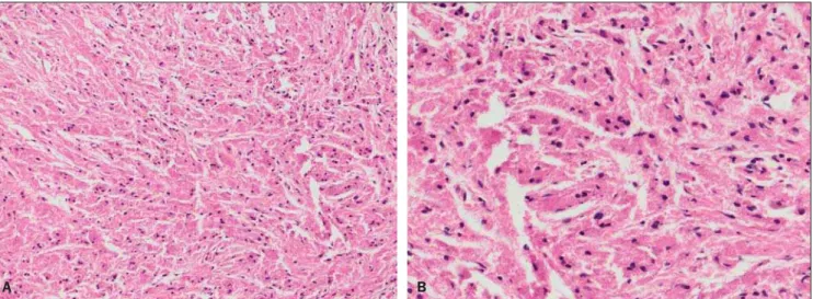 Figure 2. Granular cell tumor. Anatomopathologic study demonstrating cells with abundant rose granular cytoplasm and small eccentric nuclei (hematoxylin- (hematoxylin-eosin stain, 200x and 400x magnification).