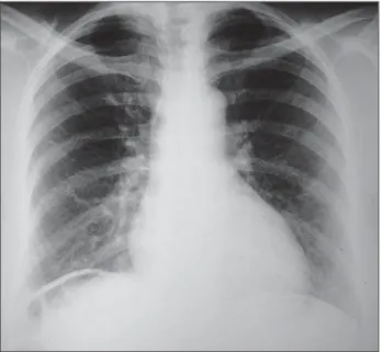 Figure 1. Chest radiography in orthostasis demonstrating the presence of air within the right hepatodiaphragmatic space.