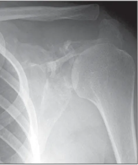 Figure 1. Frontal radiograph of left shoulder dem- dem-onstrating cortical bone rupture and fragmentation of the upper half of the scapula, with a relative  pres-ervation of the distal segment
