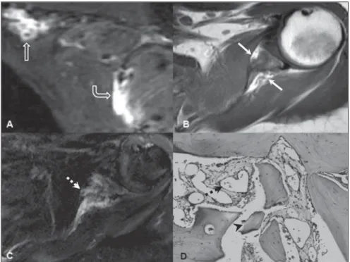 Figure 3. Magnetic resonance imaging and histopathology. A: Sagittal STIR image demonstrating marked hypersignal on the scapular body (open circle arrow) and an also hyperintense expansile extraosseous suprascapular component (straight open-headed arrow), 