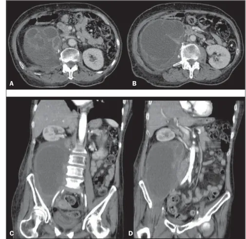 Figura 1. Radiografia de abdome. Figura 2. Tomografia computadorizada de abdome, cortes axiais (A,B) e coronais (C,D), pós-contraste.