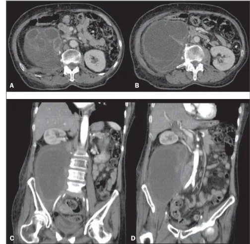 Figure 1. Abdominal radiography. Figure 2. Abdominal computed tomography, contrast-enhanced axial sections (A,B) and coronal sec- sec-tions (C,D).