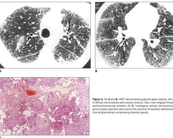 Figure 2. On A and B, HRCT demonstrating ground-glass opacity, with finding of diffuse micronodules and nodular scissure