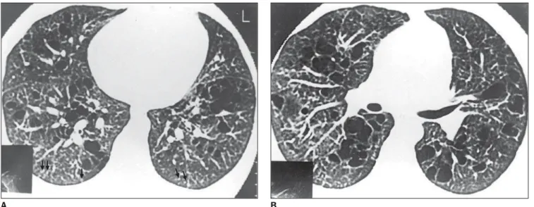 Figure 1. HRCT. Nodules < 5 mm, peripherally distributed in the lungs, particularly in the posterior regions (arrows)