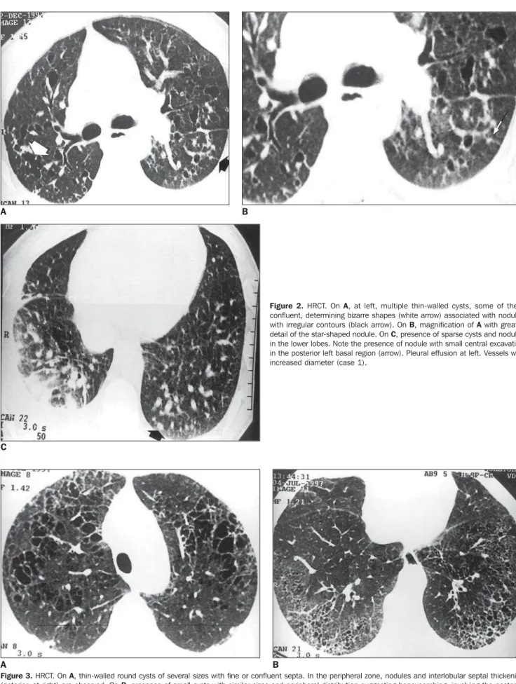 Figure 3. HRCT. On A, thin-walled round cysts of several sizes with fine or confluent septa