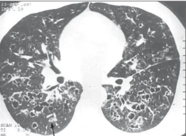 Figure 4. HRCT. Round, lobulated, confluent and bizarre cysts, with varied wall thicknesses