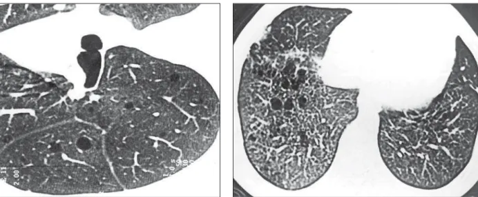 Figure 6. HRCT. Rare and sparse thin-walled cysts throughout the lungs, with preserved pulmonary parenchyma intermingled with lesions