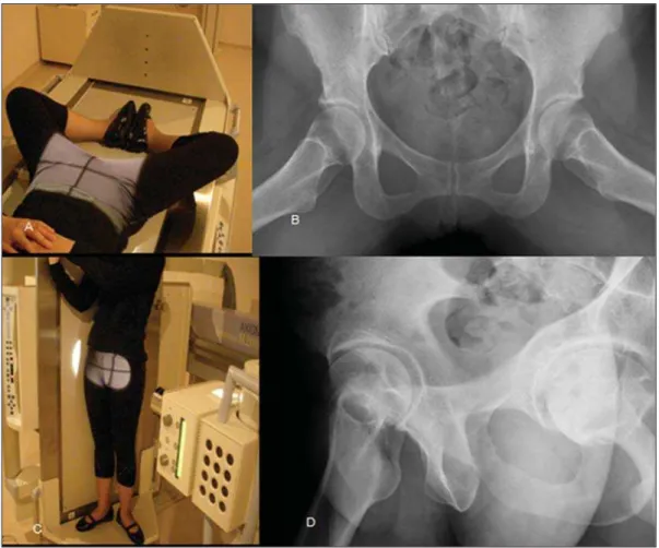 Figure 3. Lauenstein positioning (A) and view (B). Lequesne positioning (C) and view (D).