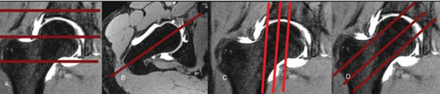 Figure 6. A: Multiplanar reconstruction in coronal, sagittal oblique and axial planes, respectively
