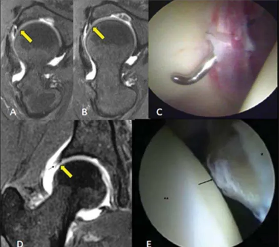 Figure 9. A,B: Chondrolabral junc- junc-tion tear at the antero-superior  por-tion of the acetabular labrum  (ar-row), filled by contrast medium at MRI arthrography, sagittal oblique plane